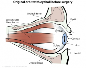 Original eye orbit with eyeball before surgery