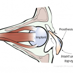 eye prosthesis entering eye socket with orbital implant