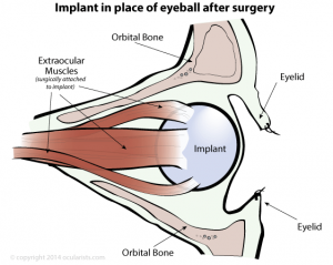 Orbital eye implant in place of eyeball after surgery (enucleation)