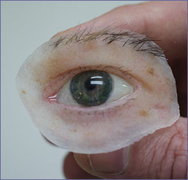 close up of orbital prosthesis with prosthetic eye