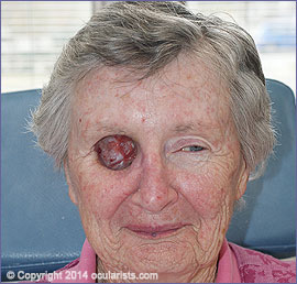 exenteration patient not wearing orbital prosthesis