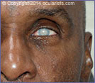 patient with phthisical or damaged eyeball