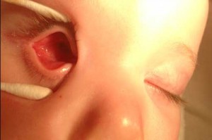 close up of infant microphthalmic eye socket